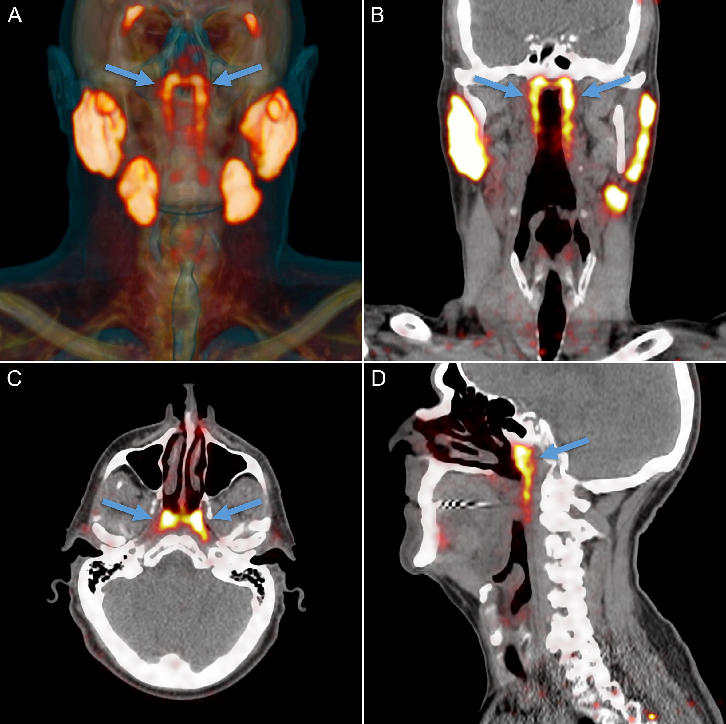 新臓器の位置を示したPSMA-PET/CTの画像。矢印で示されているのが新臓器。